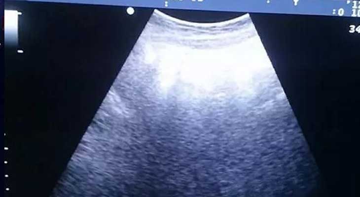 广州传承生殖医学靠谱[代孕那些比较好]+试管婴儿移植手术前要憋尿吗？(多囊